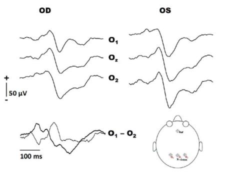 Visual evoked potentials: klinisch relevant! 