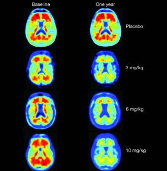 Aducanumab verlaagt de hoeveelheid Aβ-plaques bij de ziekte van Alzheimer