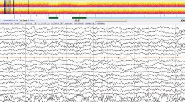 Multidisciplinaire samenwerking bij carotisendarteriëctomie