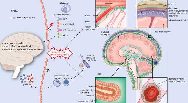 Neuropsychiatrische systemische lupus erythematodes: een zeldzaam en veelzijdig ziektebeeld