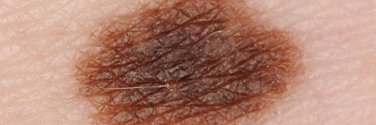 Herkennen van goedaardige en kwaadaardige huidafwijkingen