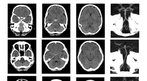 Diagnostiek bij patiënten met verdenking op een aneurysmatische subarachnoïdale bloeding