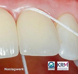 Nazorg bij implantaten