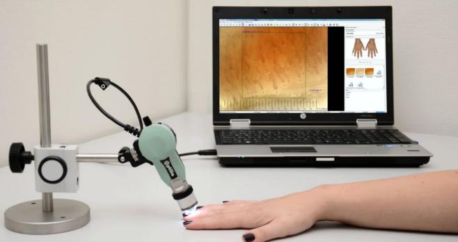 De meerwaarde van nagelriemcapillarimicroscopie bij reumatische systeemziekten