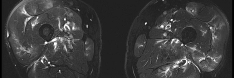 Perivasculair oedeem op de MRI bij polyarteriitis nodosa 