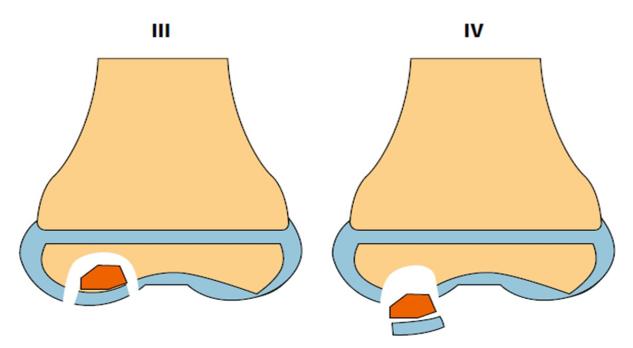 Osteochondritis dissecans van de knie (AF, BD)