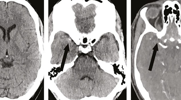 Acute behandeling van herseninfarct