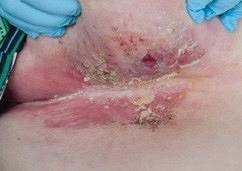 Het ulcererend mammacarcinoom