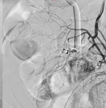 Interventieradiologische behandeling van acute bloedingen