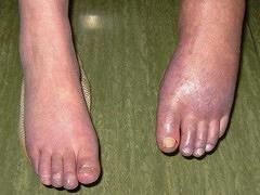 Complex regionaal pijnsyndroom