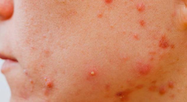Acne vulgaris