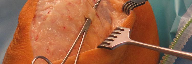 Diagnostiek en therapie bij patellofemorale instabiliteit