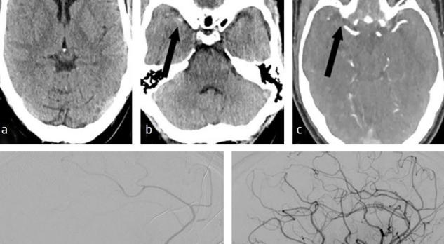 Acute behandeling van het herseninfarct