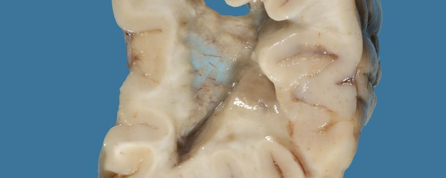 Vanishing white matter: een ziekte van de cellulaire stressrespons