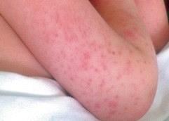 Richtlijn koorts bij kinderen