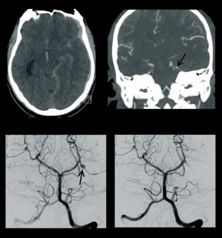 Radiologische kenmerken van het reversibele cerebrale vasoconstrictiesyndroom (RCVS) 