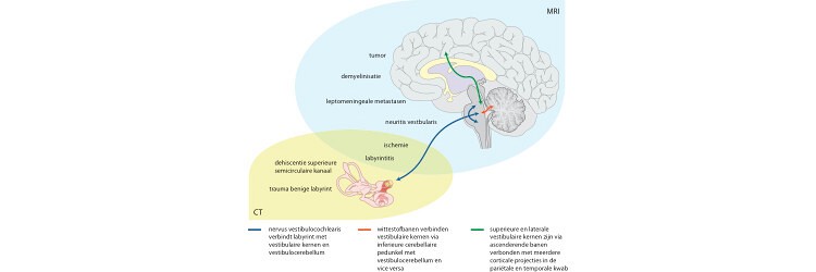 Beeldvorming bij acute vertigo