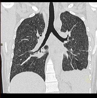 Tuberculose van het centrale zenuwstelsel