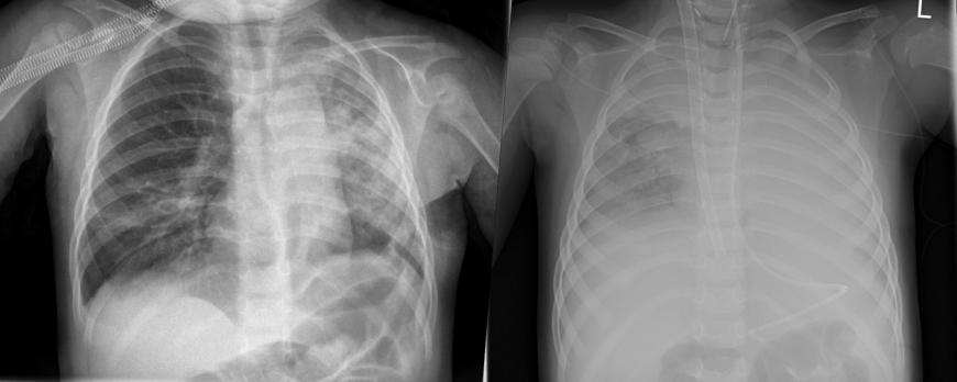 Extracorporele membraanoxygenatie (ECMO) bij kinderen