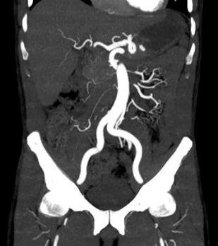 Nierinfarct: mogelijke oorzaken en passende diagnostiek