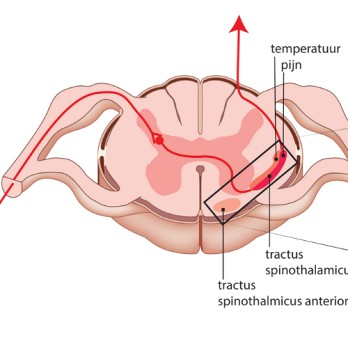 Chordotomie 