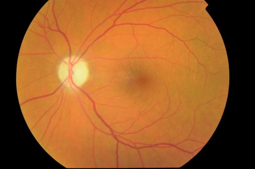 Ischemische opticusneuropathie (ion) 