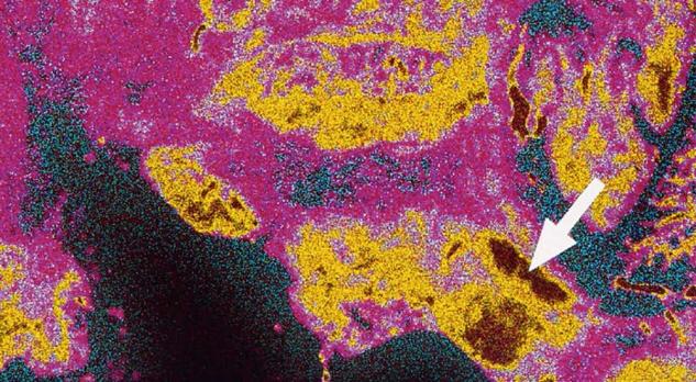 Ziekte van Parkinson