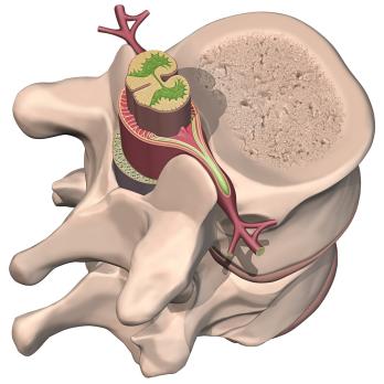 Spinaal epiduraal abces