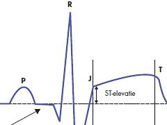Het elektrocardiogram