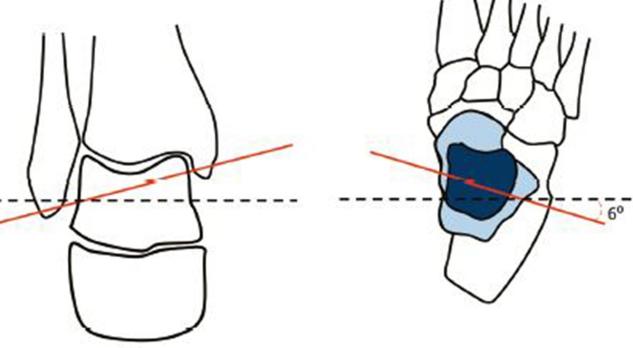 Diagnostiek en behandeling van enkelartrose (BD)