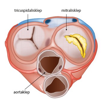 Neurologische complicaties van endocarditis 