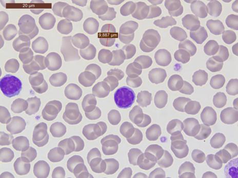 Common variable immunodeficiency