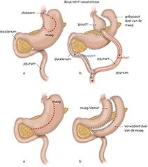  Comorbiditeit bij obesitas