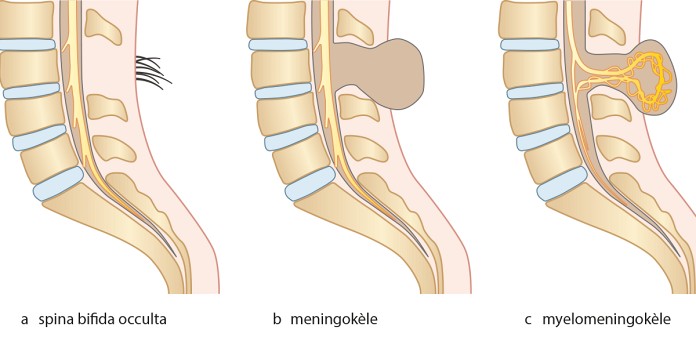 Spina bifida: multidisciplinaire zorg voor kinderen met een complexe aandoening