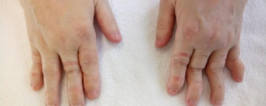 Vroege herkenning en behandeling van reumatische ontstekingsziekten (BG)