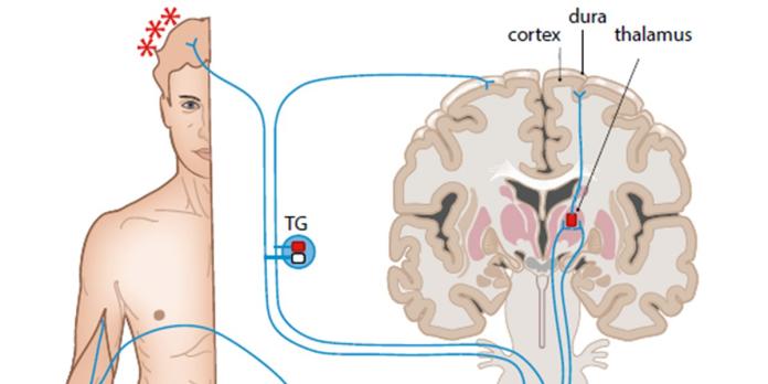 Medicatieovergebruikshoofdpijn (AF, BD)