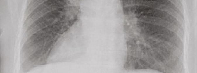 Situs inversus totalis