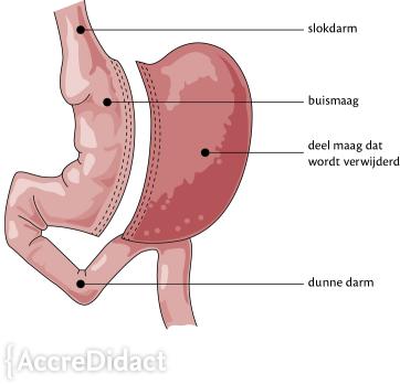 Geneesmiddelen bij obesitas en na bariatrische chirurgie