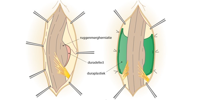 Ventrale transdurale thoracale myelumherniatie