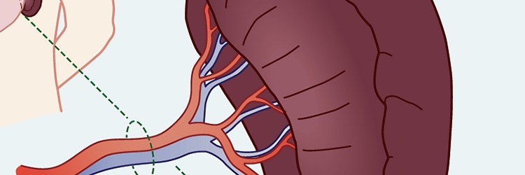 Preventiebeleid bij patiënten met een (functionele) asplenie: praktische richtlijnen voor in de praktijk