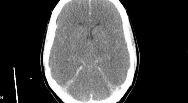 Postanoxische encefalopathie: prognose en behandeling