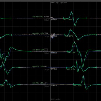 Intraoperatieve neurofysiologische monitoring van het myelum 