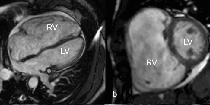 Cardiale MRI van het sporthart 