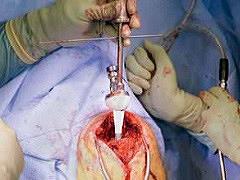 De totale schouderprothese