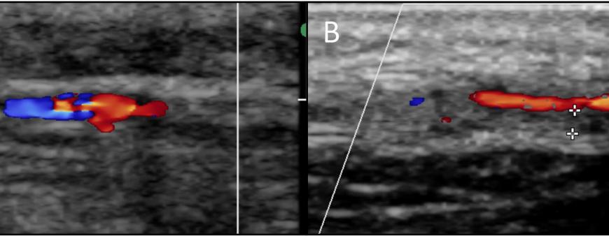 Vasculitis: een spectrum in beeld gebracht