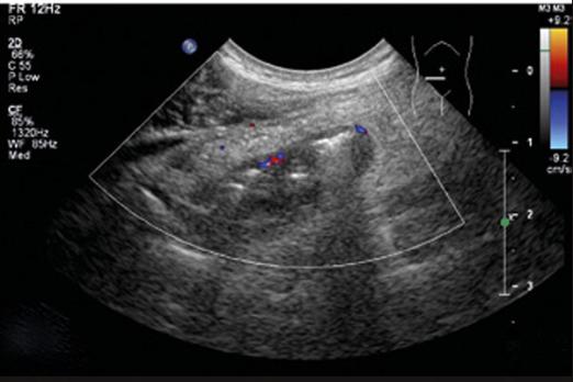 De stand van zaken: Richtlijn voor diagnostiek en behandeling van acute appendicitis (2010)