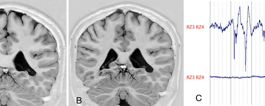Minimaal invasieve behandelingen, met name radiofrequente thermocoagulatie, bij focale epilepsie