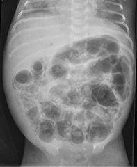 Necrotiserende enterocolitis