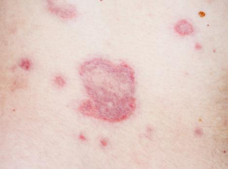 Urticaria en angio-oedeem bij kinderen