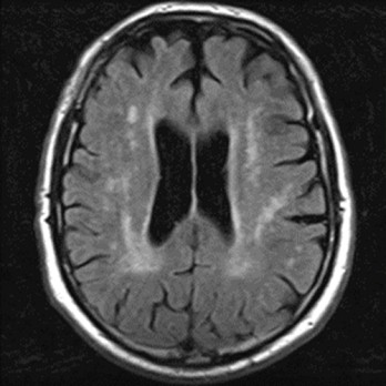 Vasculaire dementie als gevolg van het antifosfolipidesyndroom 